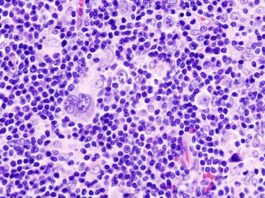 Major Improvements In Treating Hodgkin’s Lymphoma