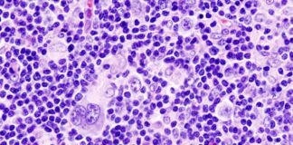 Major Improvements In Treating Hodgkin’s Lymphoma