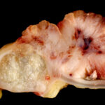 Colon Cancer